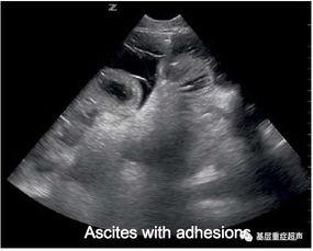 膀胱穿刺术视频,膀胱穿刺术操作步骤及要点解析