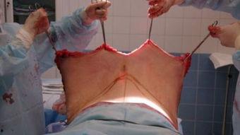 抽脂全程视频,抽脂手术的神奇蜕变之旅